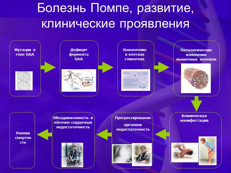 Болезнь Помпе, развитие, клинические проявления Мутации в  гене GAA  Дефицит фермента GAA